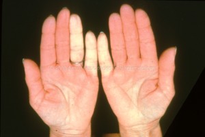 Scleroderma: Raynaud's Phenomenon, Blanching of Hands